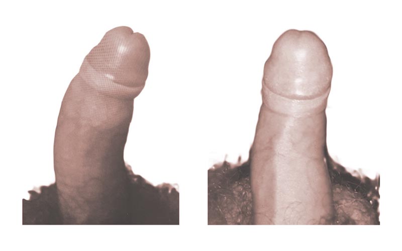 pene curvo caso 6